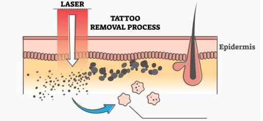 Laser Tattoo Removal Process
